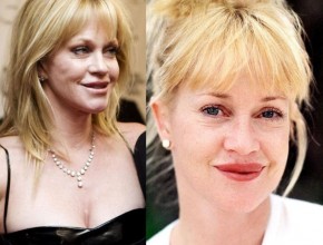 Melanie Griffith before and after plastic surgery 06