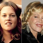 Melanie Griffith before and after plastic surgery 08