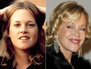 Melanie Griffith before and after plastic surgery 08