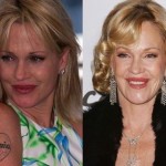Melanie Griffith before and after plastic surgery 09