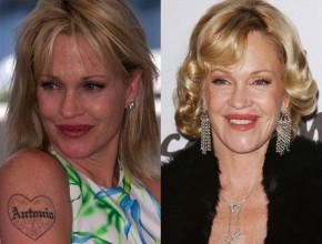 Melanie Griffith before and after plastic surgery 09