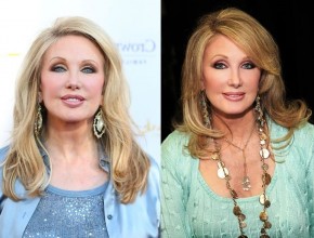 Morgan Fairchild before and after plastic surgery 07