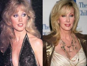 Morgan Fairchild before and after plastic surgery 08