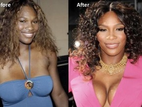 Serena Williams before and after breasts augmentation