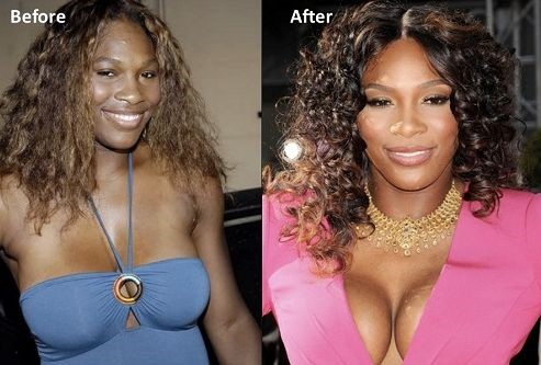 Serena Williams before and after breasts augmentation