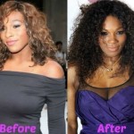 Serena Williams before and after breasts lift 01