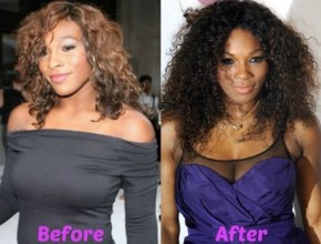 Serena Williams before and after breasts lift 01
