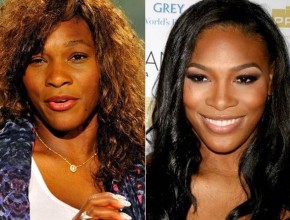 Serena Williams before and after plastic surgery