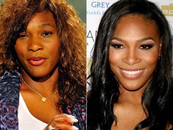 Serena Williams before and after plastic surgery