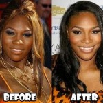 Serena Williams before and after plastic surgery 04