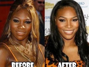 Serena Williams before and after plastic surgery 04