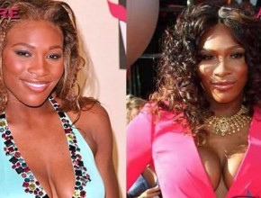 Serena Williams before and after plastic surgery 05