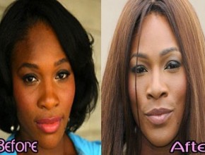 Serena Williams before and after plastic surgery 06