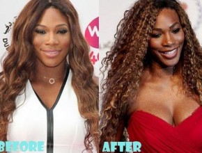 Serena Williams before and after plastic surgery 07