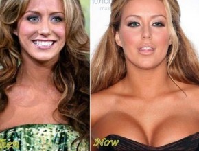 Aubrey O'Day before and after plastic surgery