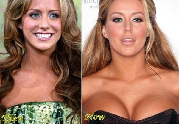Aubrey O'Day before and after plastic surgery