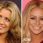 Aubrey O'Day before and after plastic surgery 02