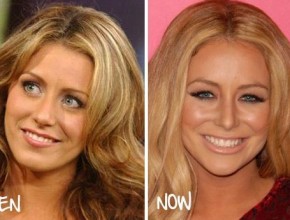 Aubrey O'Day before and after plastic surgery 02
