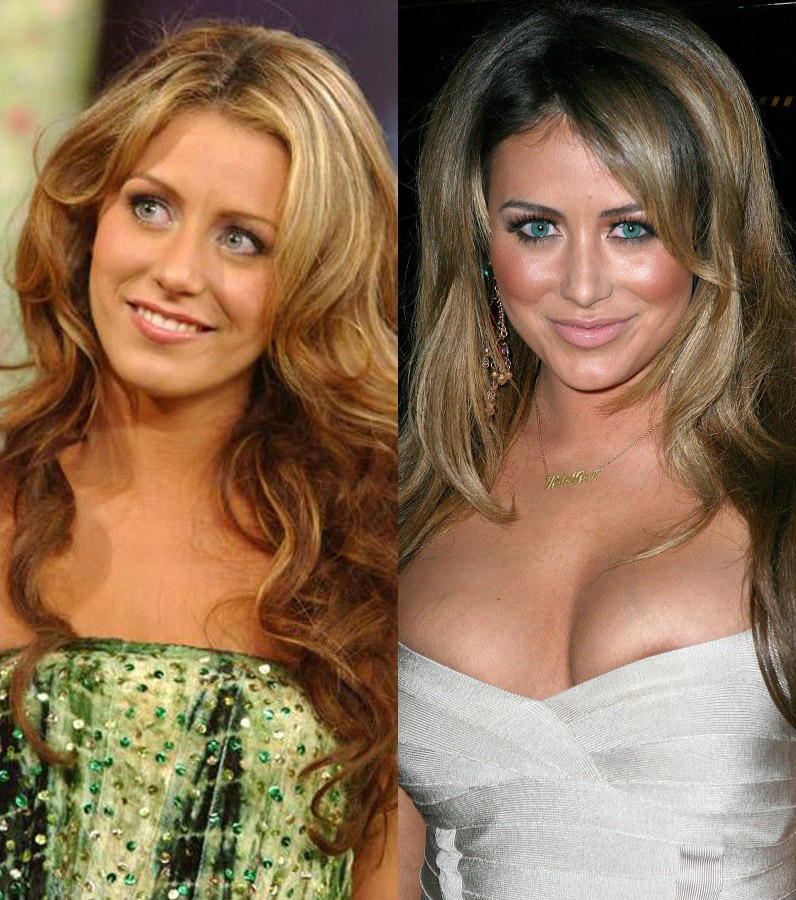 Aubrey O’Day before and after plastic surgery.