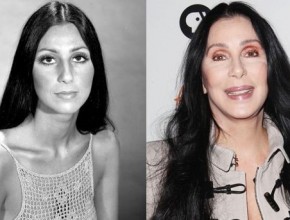 Cher before and after plastic surgery 02