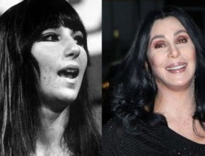 Cher before and after plastic surgery 03