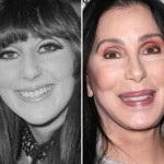Cher before and after plastic surgery 04