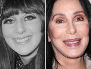 Cher before and after plastic surgery 04