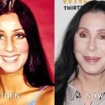 Cher before and after plastic surgery 05
