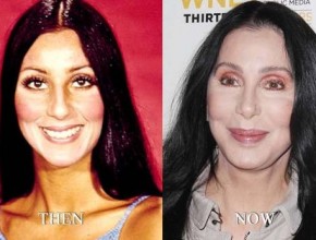 Cher before and after plastic surgery 05