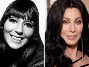 Cher before and after plastic surgery
