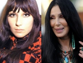 Cher before and after plastic surgery