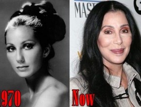 Cher before and after plastic surgery