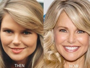 Christie Brinkley before and after plastic surgery 04