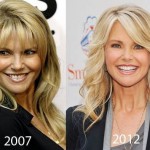 Christie Brinkley before and after plastic surgery 05