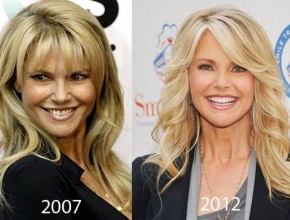 Christie Brinkley before and after plastic surgery 05