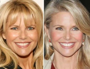 Christie Brinkley before and after plastic surgery 07