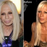 Donatella Versace after and before plastic surgery