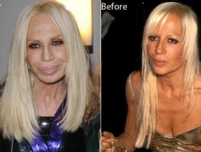 Donatella Versace after and before plastic surgery