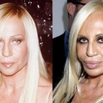 Donatella Versace before and after plastic surgery 01