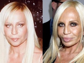 Donatella Versace before and after plastic surgery 01