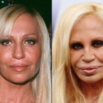 Donatella Versace before and after plastic surgery 02