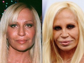 Donatella Versace before and after plastic surgery 02