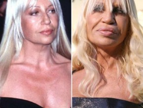 Donatella Versace before and after plastic surgery