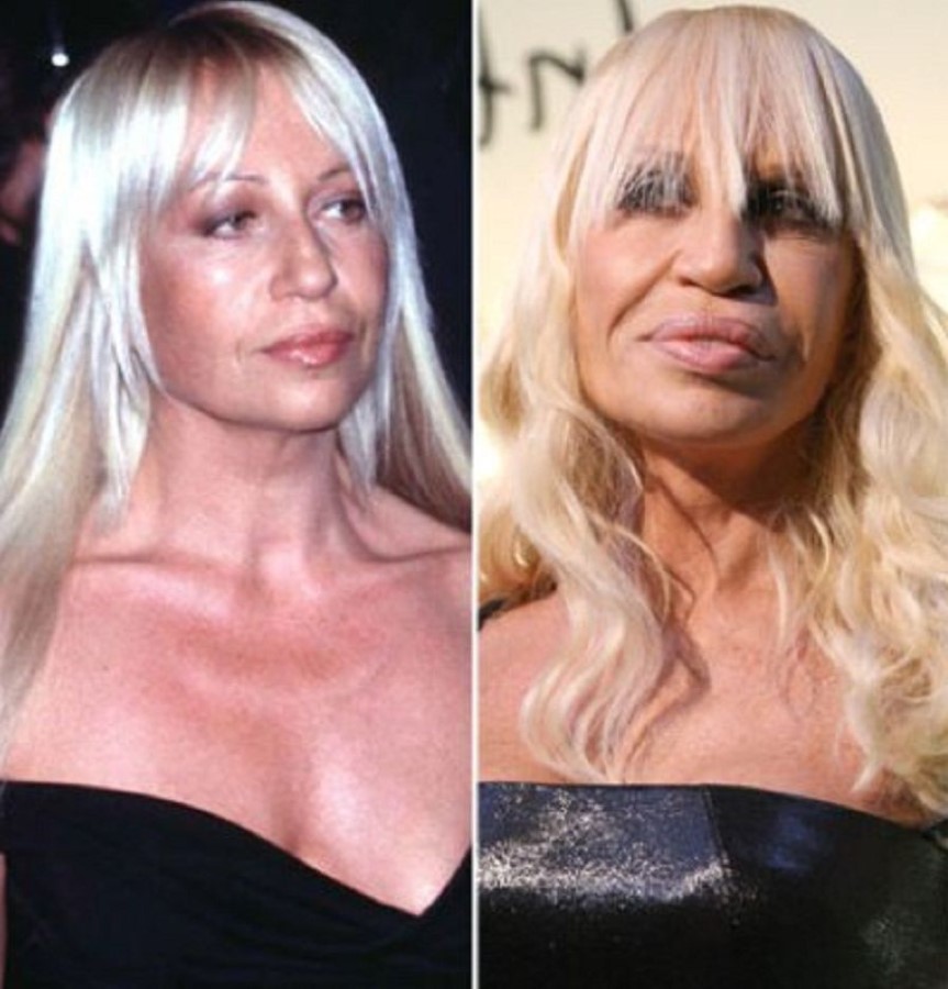 Donatella Versace before and after plastic surgery