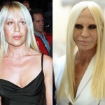 Donatella Versace before and after plastic surgery 04