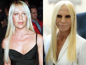 Donatella Versace before and after plastic surgery 04