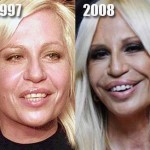 Donatella Versace before and after plastic surgery 05