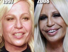 Donatella Versace before and after plastic surgery 05