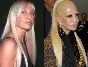 Donatella Versace before and after plastic surgery