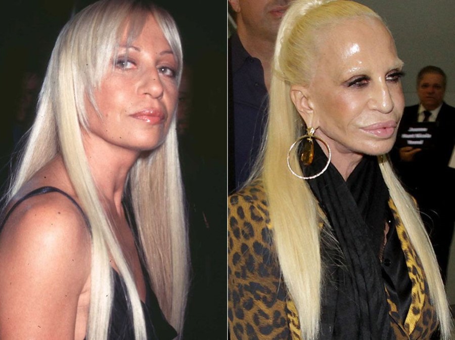 Donatella Versace before and after plastic surgery